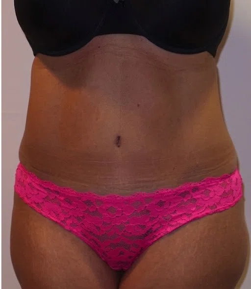 Before &mdash; Tummy Tuck in Mexico City